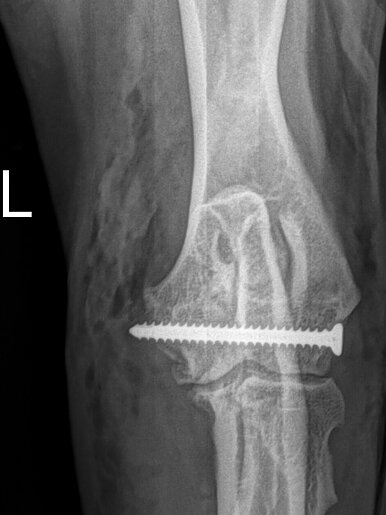 Humeral Intracondylar Fissure: Post OP