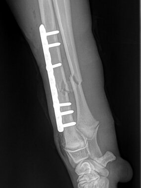 Diaphysäre Radius-Ulna-Querfraktur links, Hund. ll-Aufnahme post OP. 