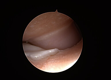 Mediales Kompartmentsyndrom: Arthroskopiebild