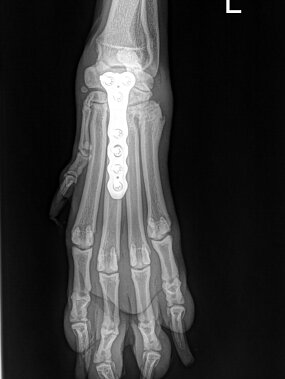 Teilarthrodese bei carpometacarpaler Instabilitätät
