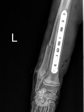 Diaphysäre Radius-Ulna-Querfraktur links, Hund. ap-Aufnahme post OP. 