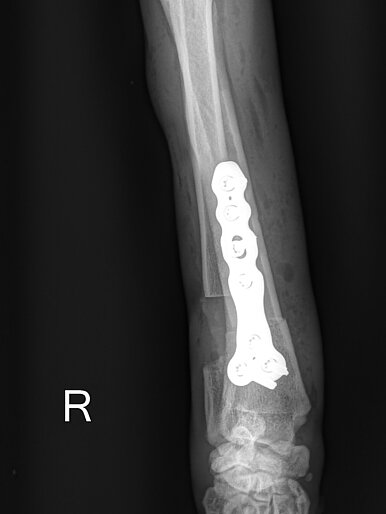 Carpus Valgus/Radius Curvus post OP