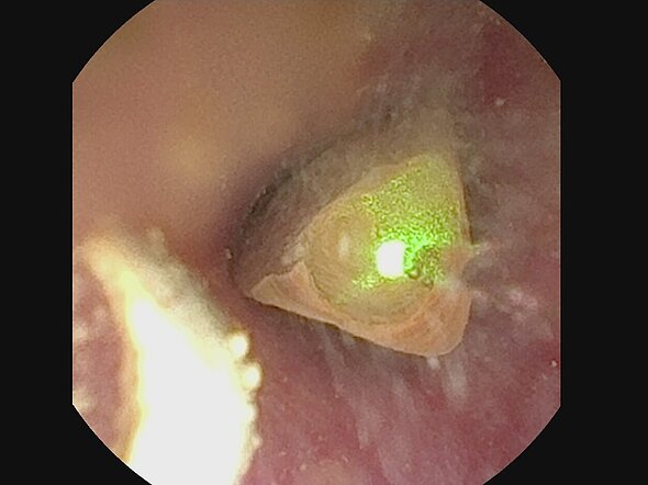 Dieses Endoskopiebild zeigt einen Harnröhrenstein, der vom Laser zertrümmert wird.
