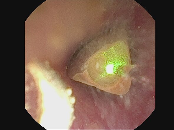 Dieses Endoskopiebild zeigt, wie ein Stein in der Harnröhre mit einem Laser zertrümmert wird. Man sieht da Licht des Lasers.