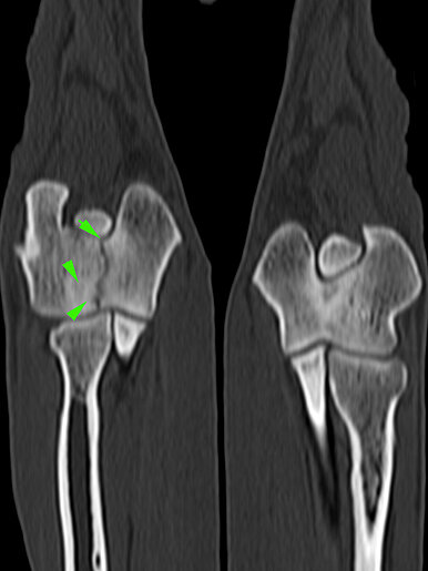 Humeral Intracondylar Fissure