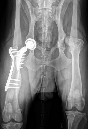 Zustand nach Totalendoprothese des Hüftgelenkes (TEP)