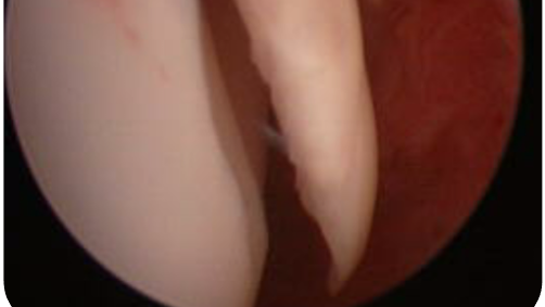 Arthroskopie mit Flap