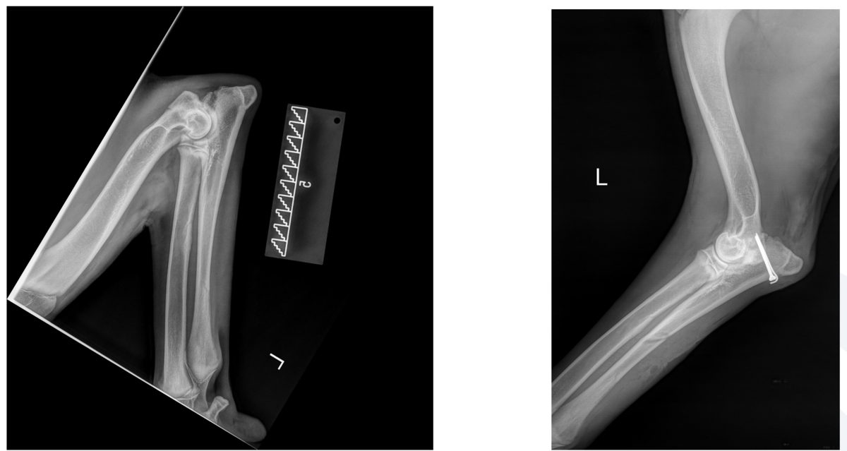 Isolierter Processus Anconaeus vor und nach OP. 