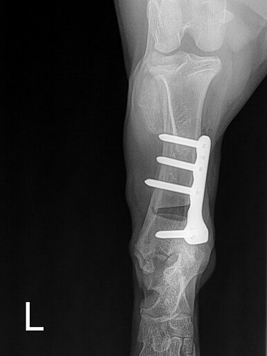 Pes varus links post OP