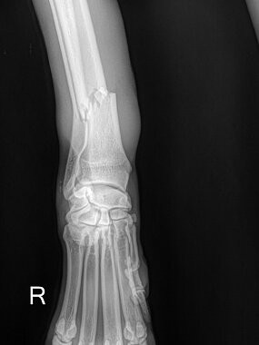 Distale Radius-Ulna-Querfraktur rechts, Hund, ap-Aufnahme prä OP. 