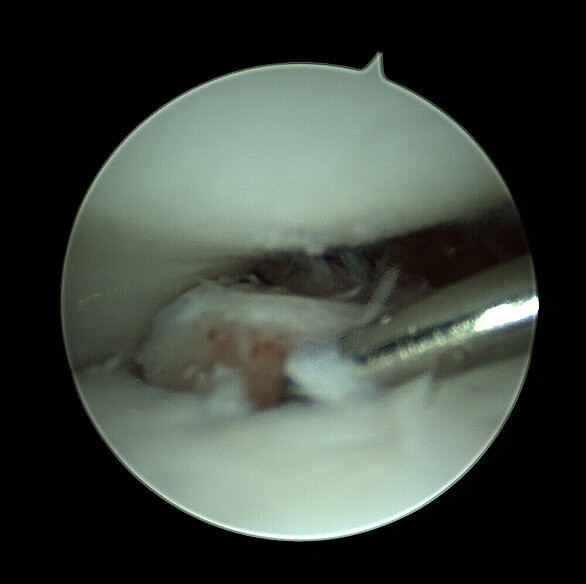 OP-Bild: Arthroskopie zur Entfernung des Fragments.