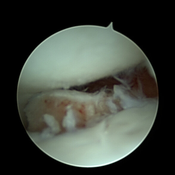 OP-Bild: Arthroskopie zur Entfernung des Fragments.
