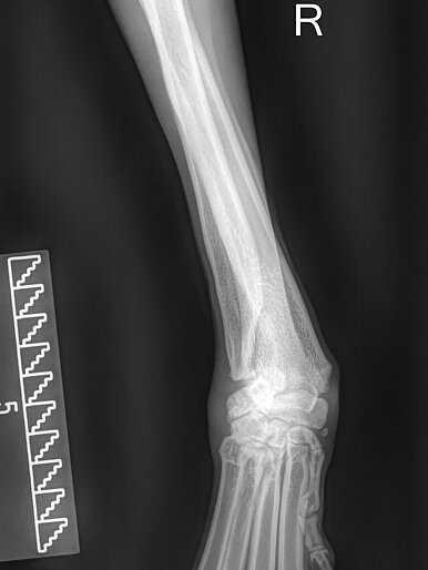 Carpus Valgus/Radius Curvus prä OP