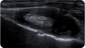 Gefüllte Sehnenscheide im Ultraschallbild