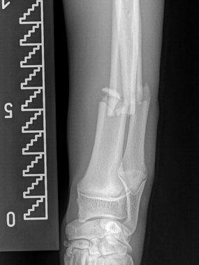 Diaphysäre Radius-Ulna-Querfraktur links, Hund. ap-Aufnahme prä OP. 