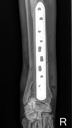 Distale Radius-Ulna-Querfraktur rechts, Hund, ap-Aufnahme post OP. 
