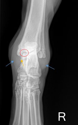 OCD Tarsus: Blauer Pfeil: mittelgradiger Gelenkerguss  Roter Kreis: medialer Talusrollkamm mit subchondralem Knorpeldefekt und erweiterten Gelenkspalt. Distal des medialen Malleolus: knochendichtes isoliertes Fragment (gelber Pfeil)