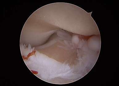 Mediales Kompartmentsyndrom: Arthroskopiebild