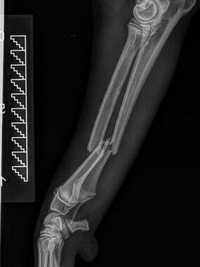 Diaphysäre Radius-Ulna-Querfraktur links, Hund. ll-Aufnahme prä OP. 
