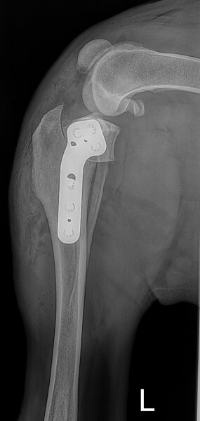 Versorgung mittels TPLO. ll-Aufnahme post OP