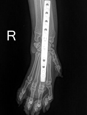 Pancarpalarthrodese rechts