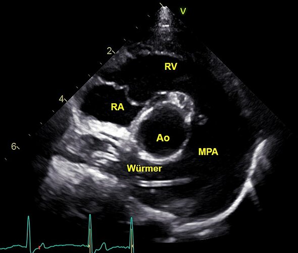 Abbildung 8: Dieser Hund zeigt einen deutlichen Wurmbefall. Man kann mehrere Würmer (Doppellamellen) in der rechten Pulmonalarterie (RPA) sehen. Ein Wurm kann fast bis zur Klappe der Hauptpulmonalarterie (MPA) verfolgt werden. Auffällig sind die deutlich erweiterten oder dilatierten Lungengefäße. 