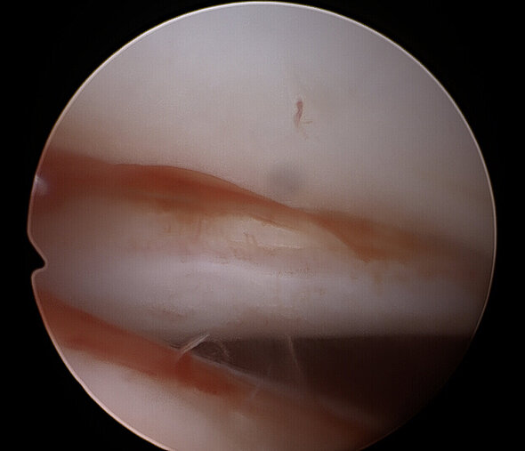 Arthroskopie-Bild: OCD im Schultergelenk
