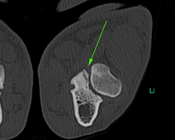 CT-Bild: Coronoid-Pathologie bei einem Hund. 