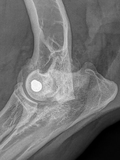 Humeral Intracondylar Fissure: Post OP