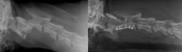 Fraktur des 2. Halswirbels. Röntgenaufnahme vor (links) und nach (rechts) Versorgung der Fraktur.