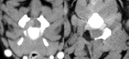 Tumor der Nervenwurzel des 5. Halswirbels vor (links) und 7 Monate nach (rechts) Operation.